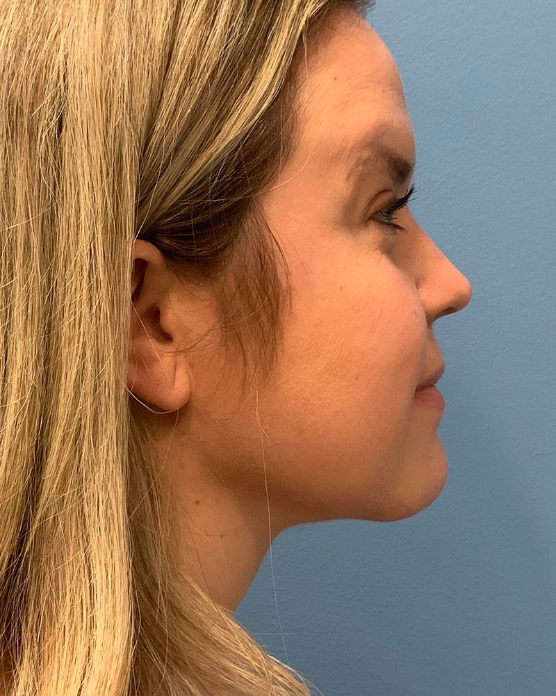 after neck lift right side view of female patient case 4236