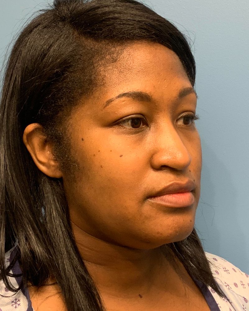 before neck lift right angle view female patient case 4241