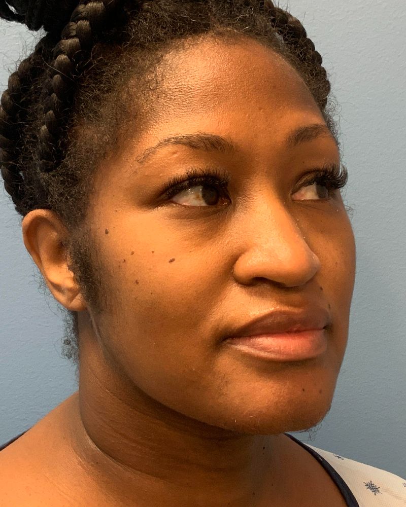 after neck lift right angle view female patient case 4241
