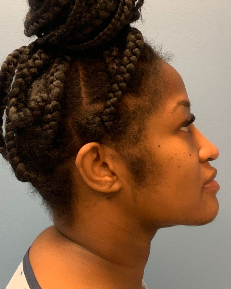 after neck lift right side view female patient case 4241