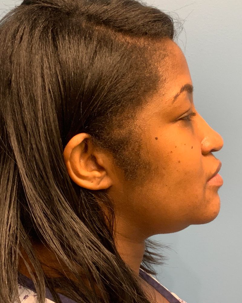 before neck lift right side view female patient case 4241