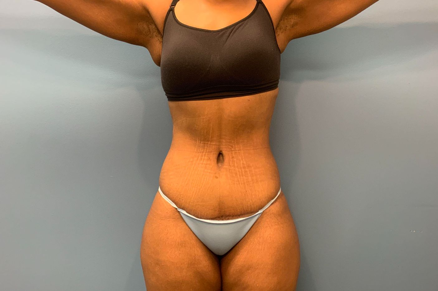 after post weightloss surgery front view female patient case 4290