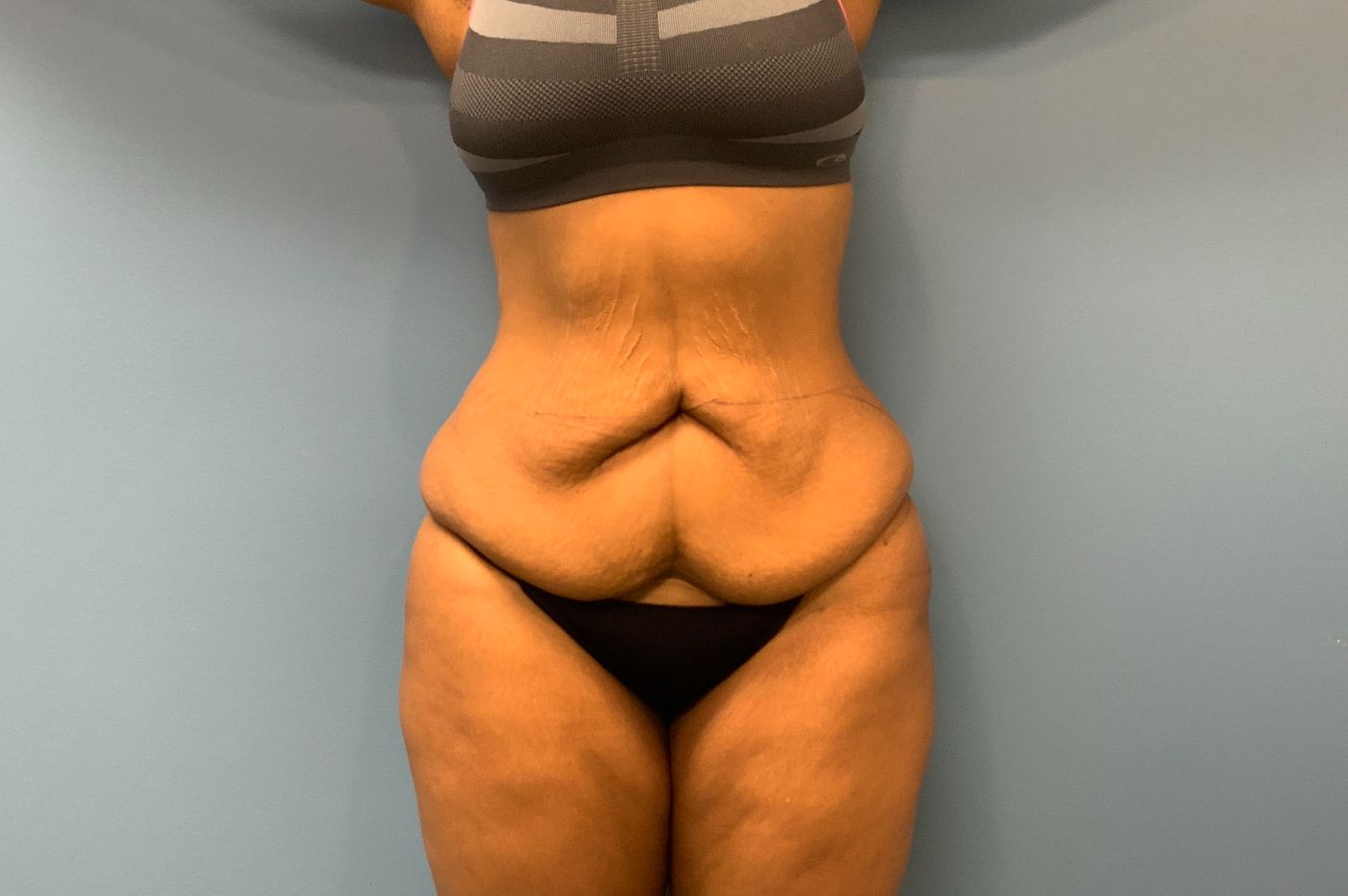 before post weightloss surgery front view female patient case 4290