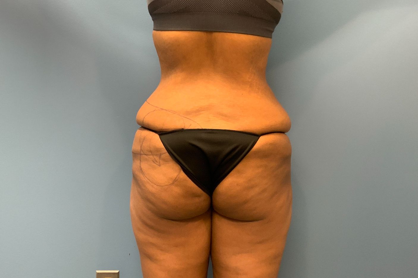 before post weightloss surgery back view female patient case 4290