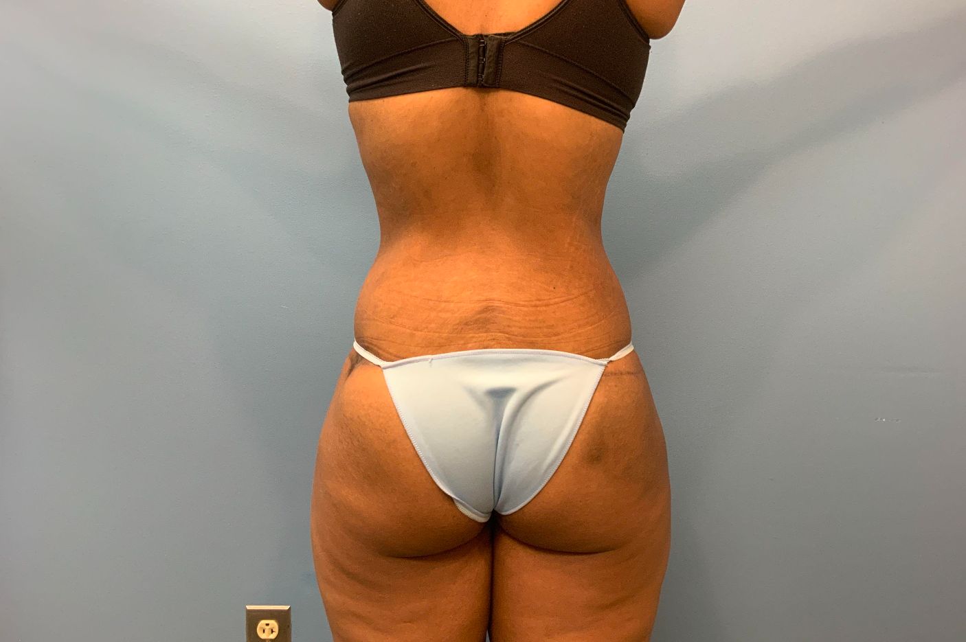 after post weightloss surgery back view female patient case 4290