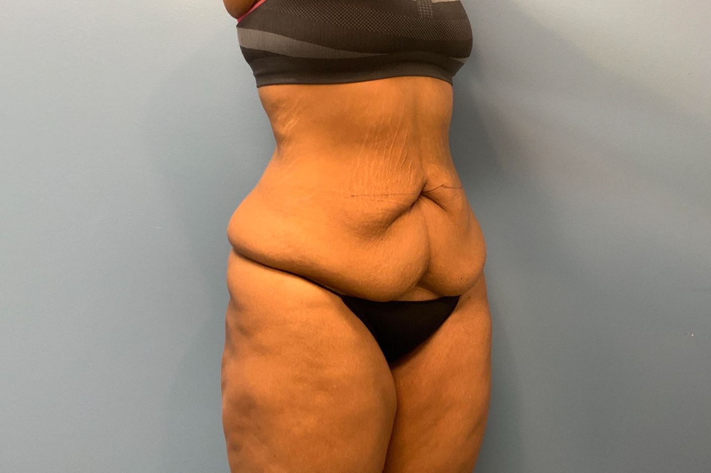 before post weightloss surgery right angle view female patient case 4290