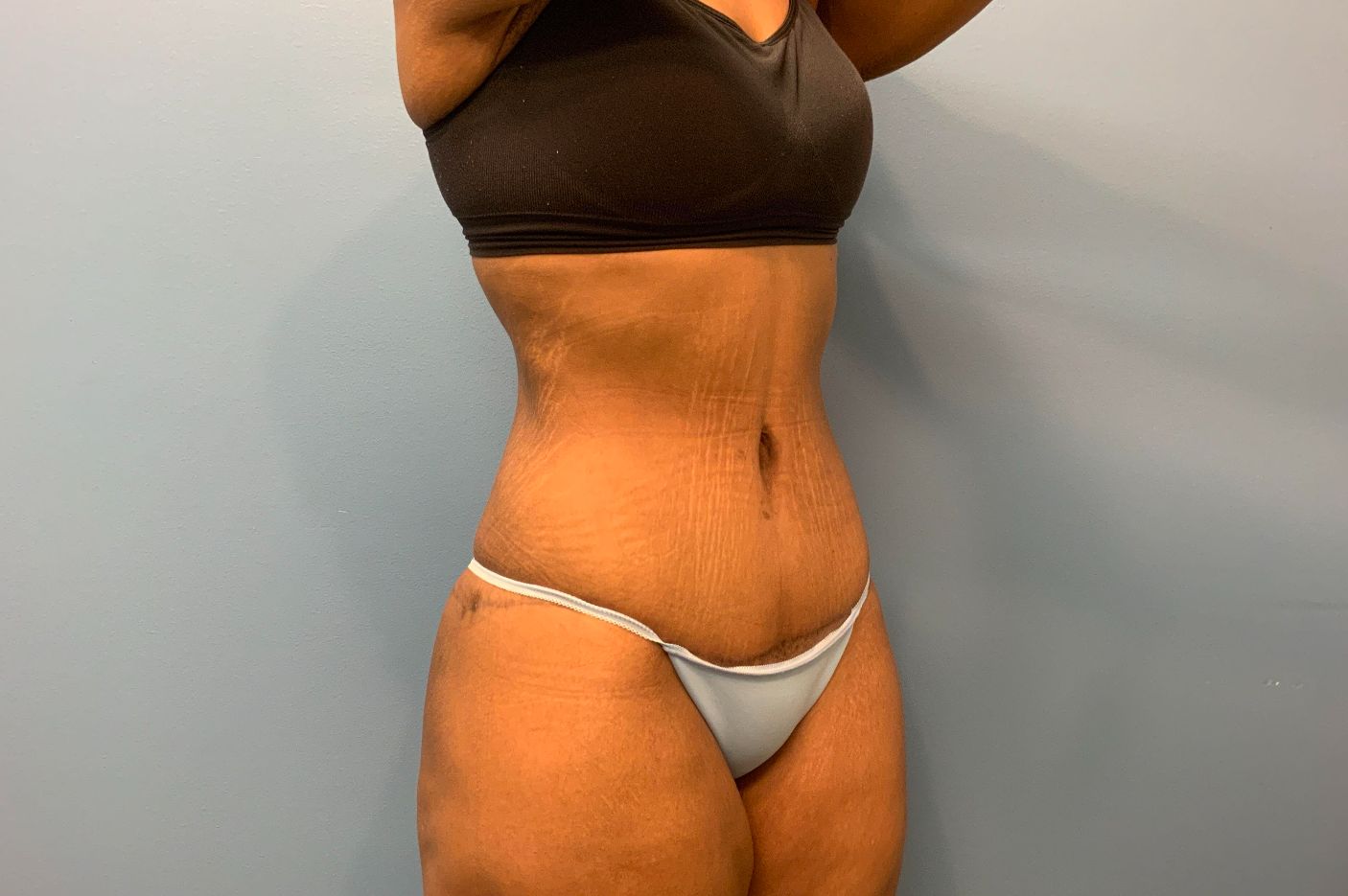 after post weightloss surgery right angle view female patient case 4290