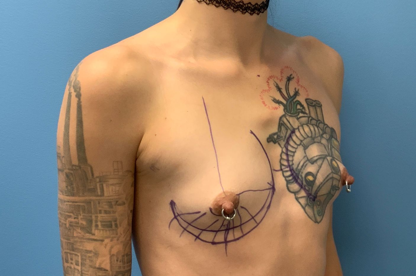 before transgender top surgery right angle view transgender patient case 4284