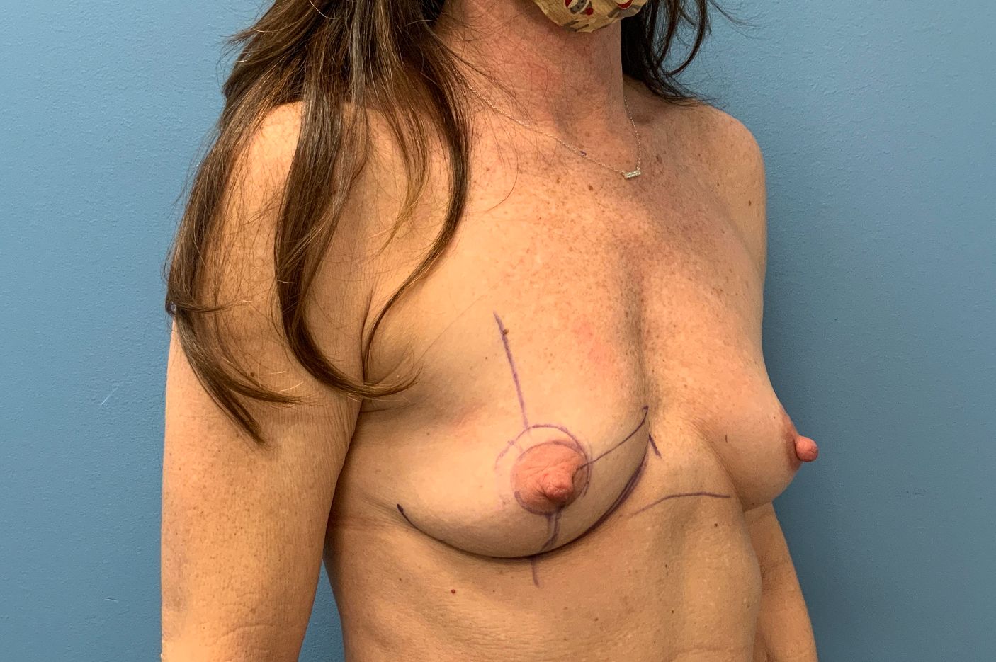 before breast augmentation right angle view female patient case 4470