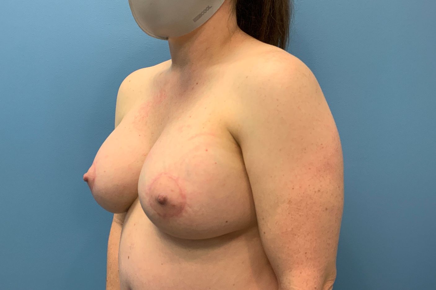 after breast augmentation lift left view female patient case 4547