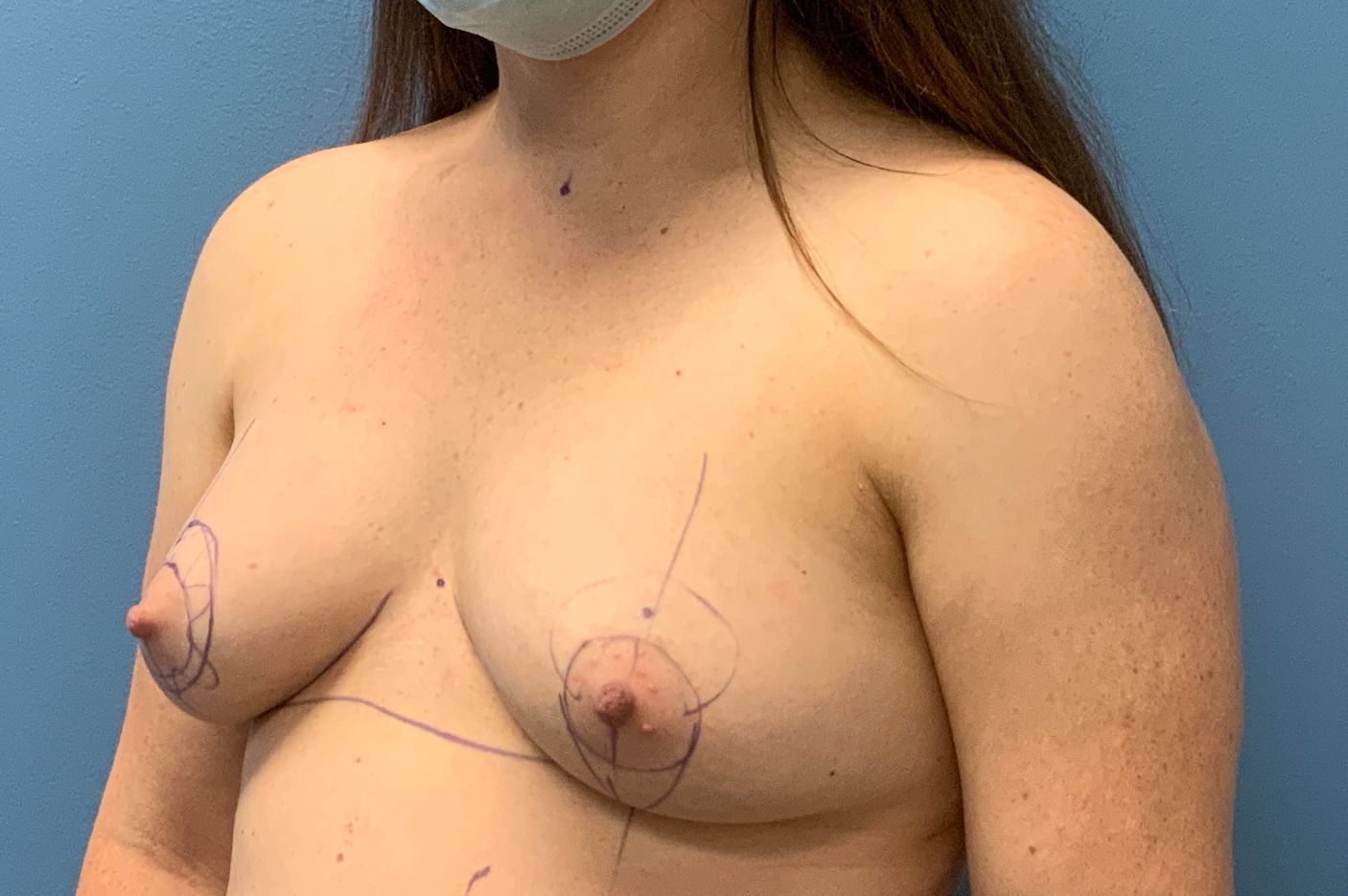 before breast augmentation lift left view female patient case 4547