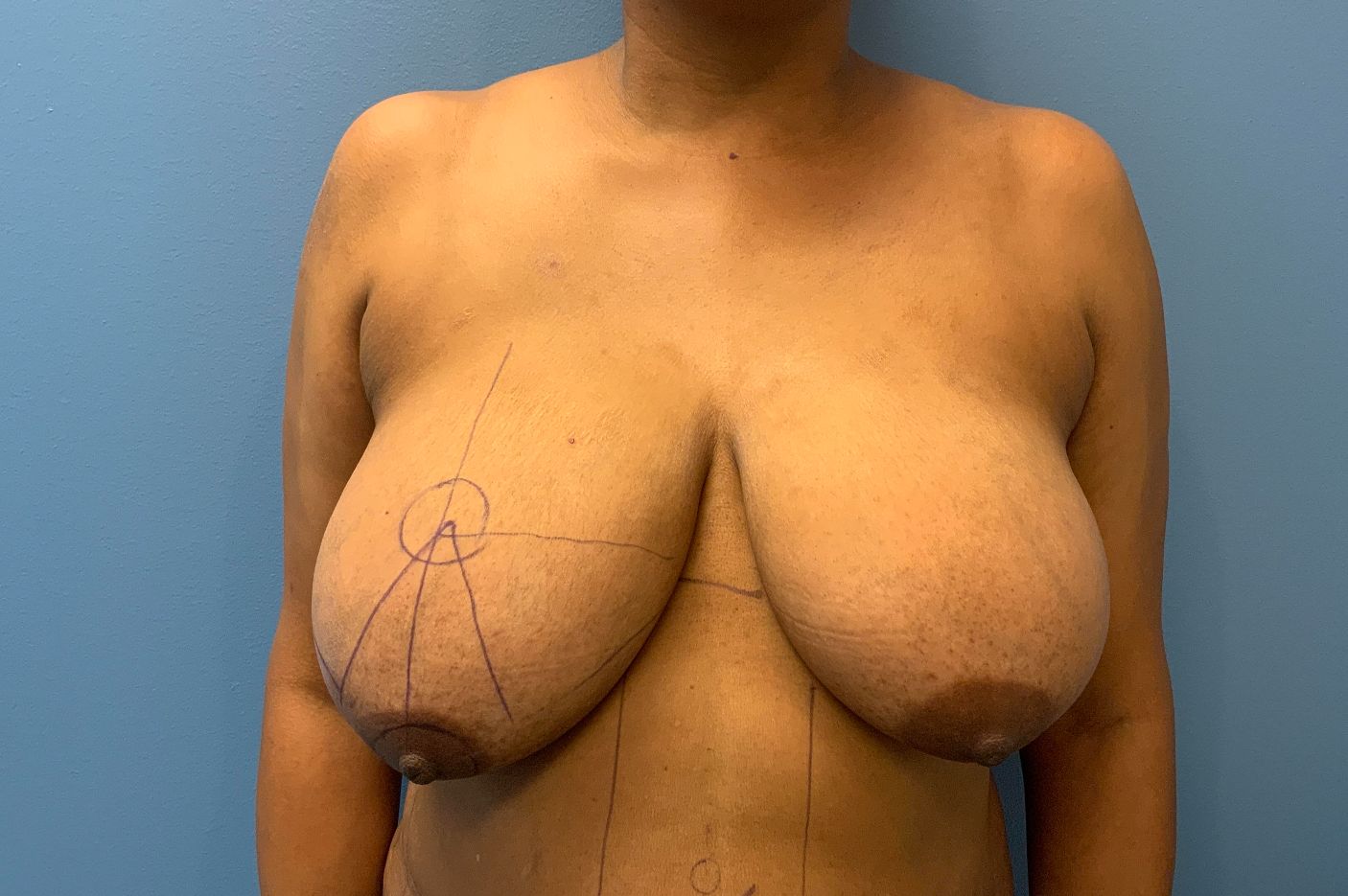 before breast lift front view female patient case 4533