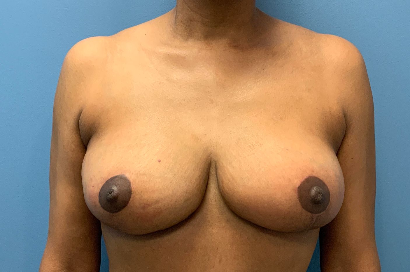 after breast lift front view female patient case 4533