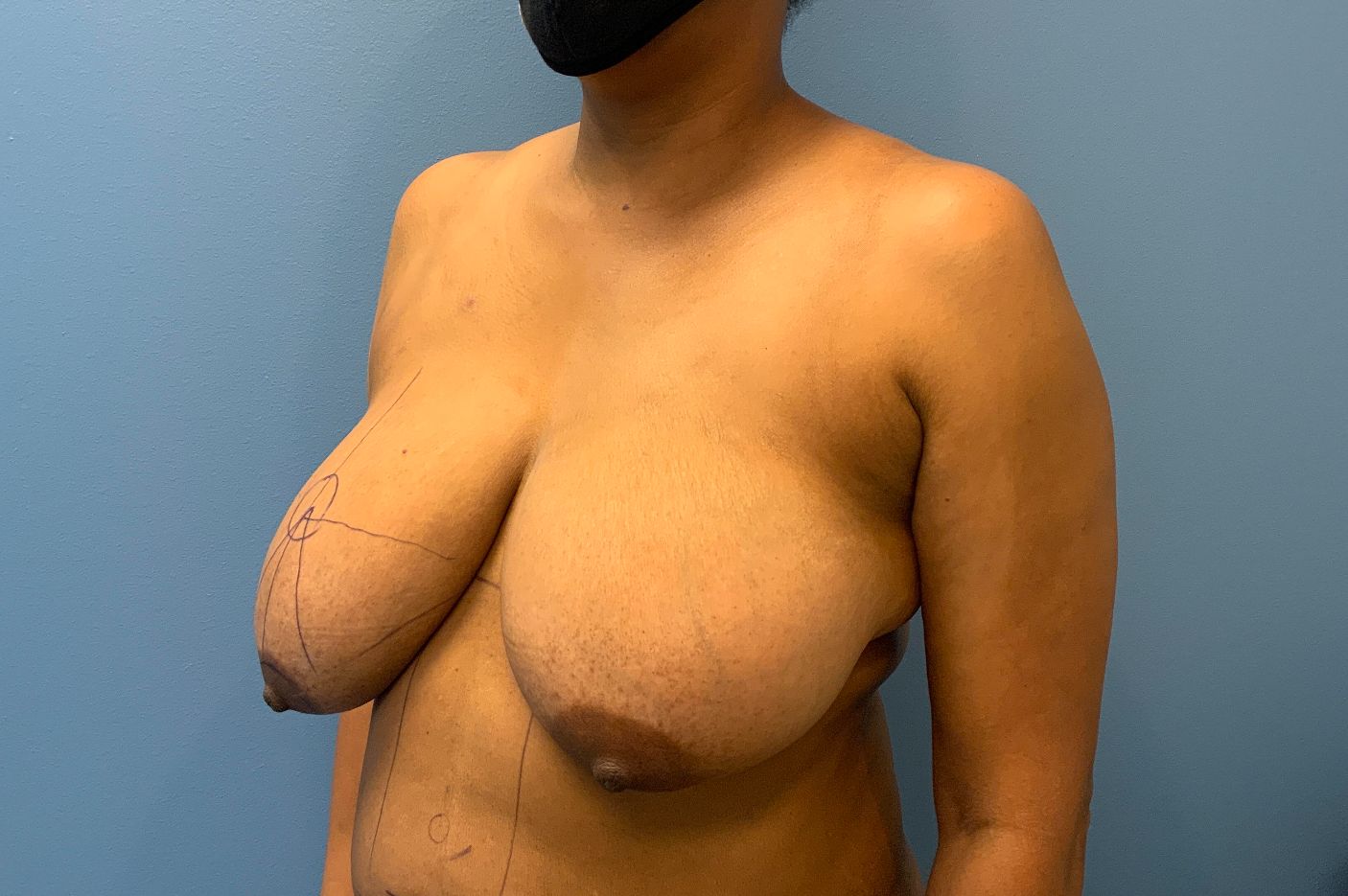 before breast lift left view female patient case 4533