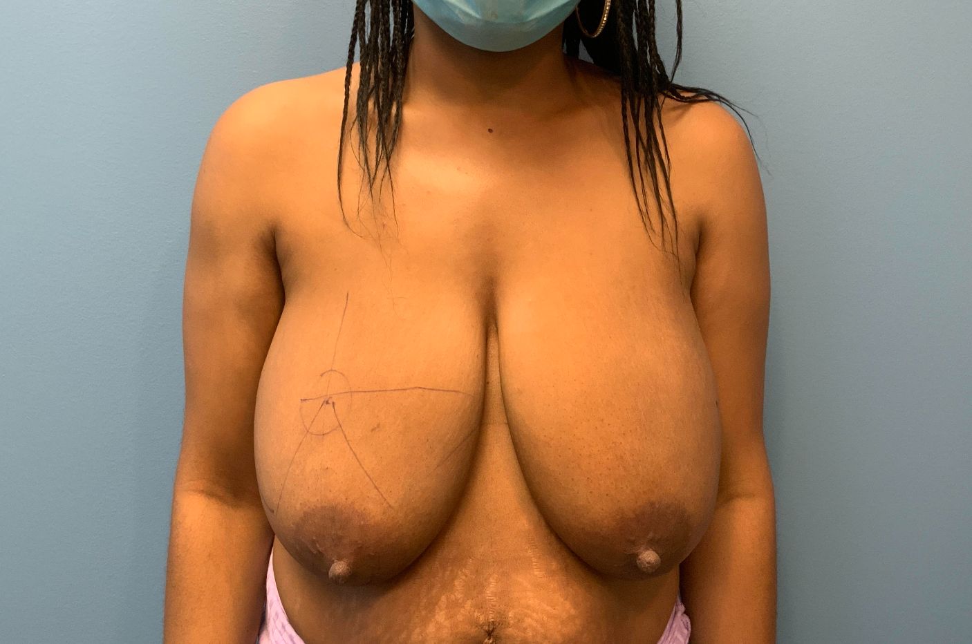 before breast reduction front view female patient case 4482