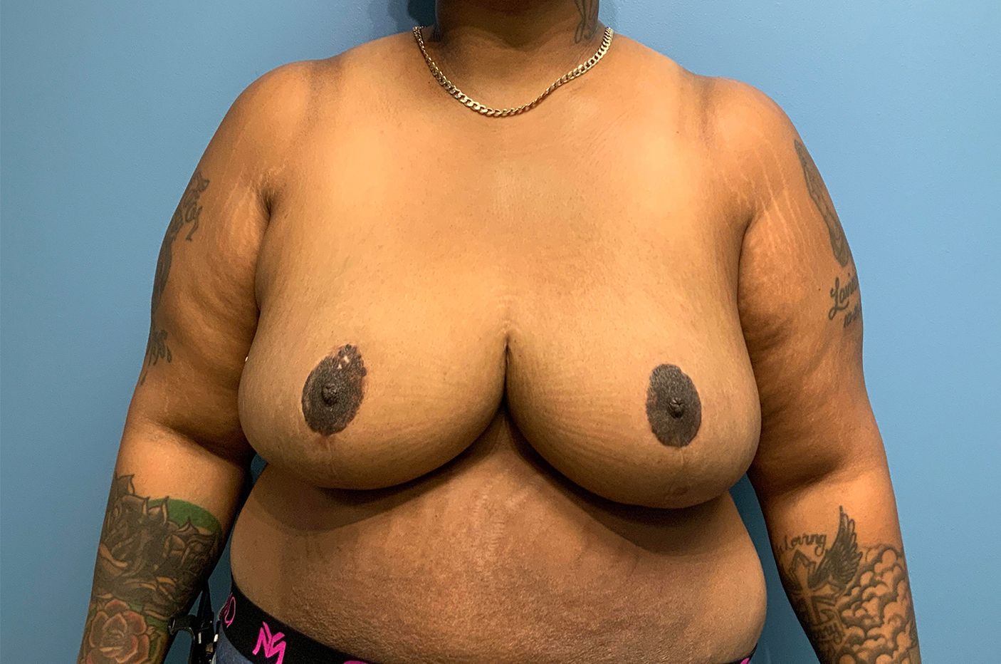 after breast reduction front view female patient case 4487