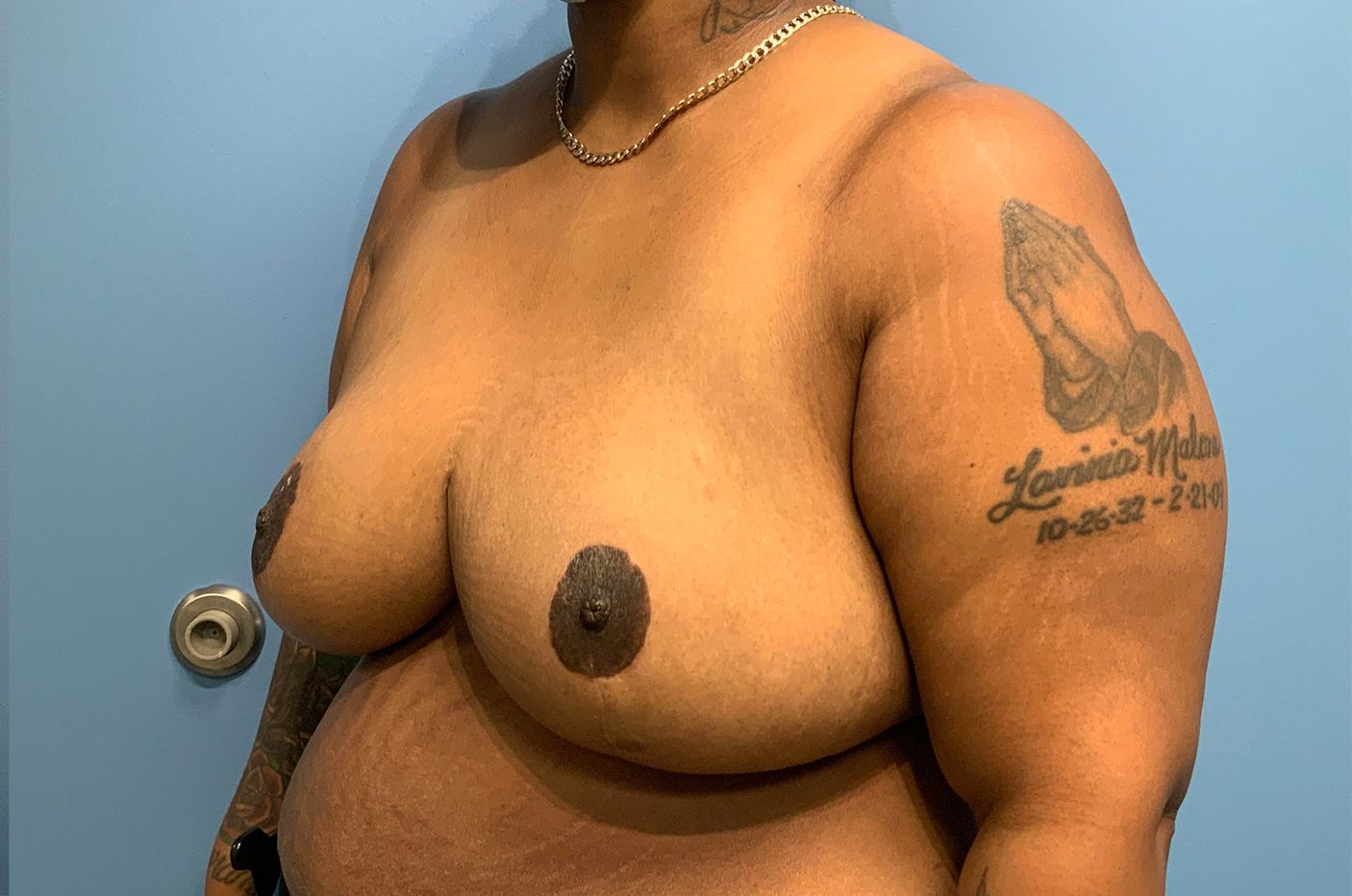 after breast reduction left view female patient case 4487