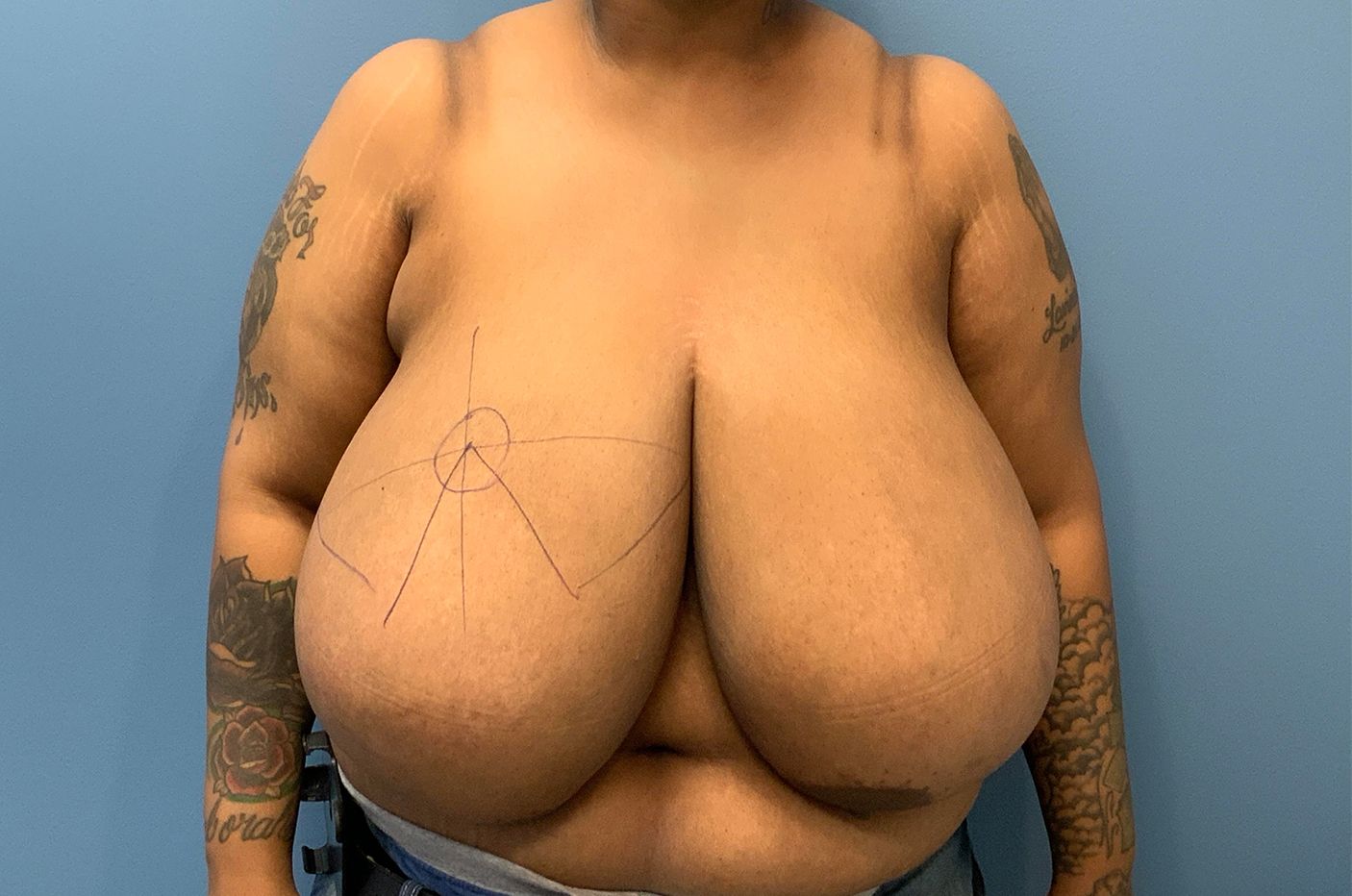before breast reduction front view female patient case 4487