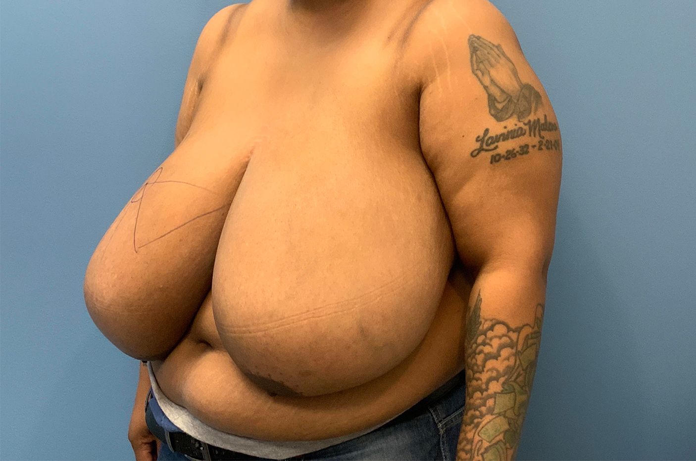 before breast reduction left view female patient case 4487
