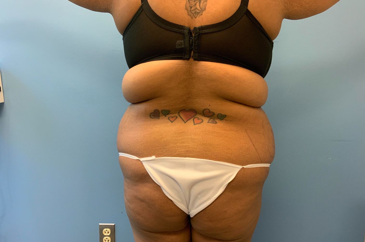 before liposuction back view female patient case 4543