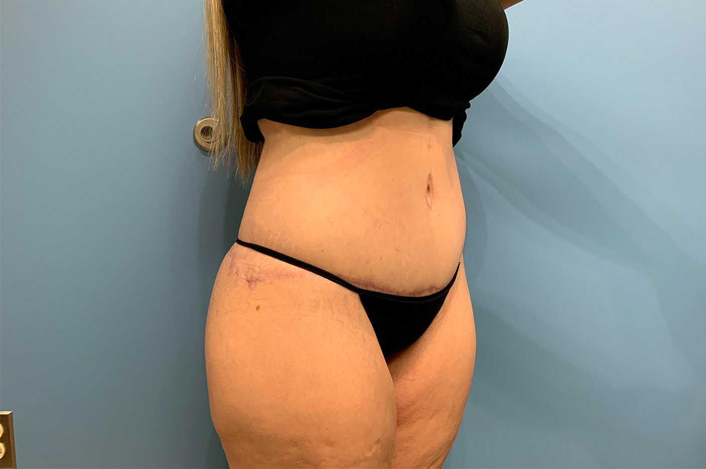 after surgery after weight loss right view female patient case 4493