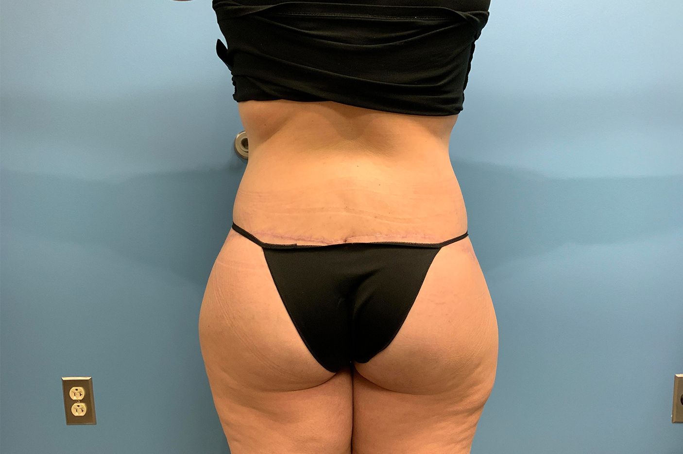 after surgery after weight loss back view female patient case 4493