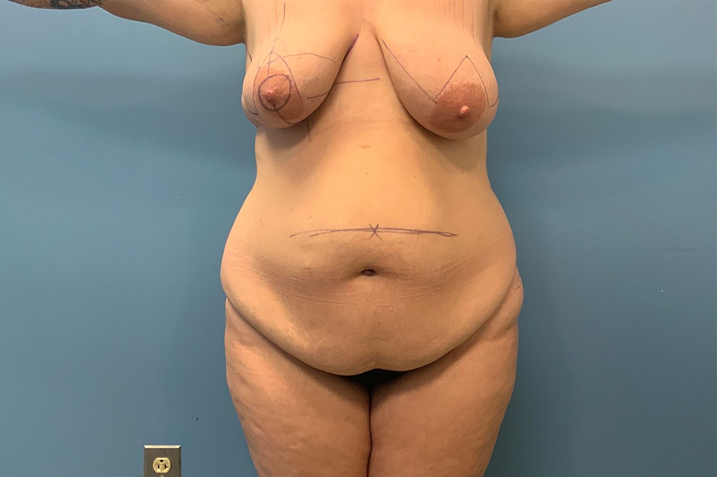 before surgery after weight loss front view female patient case 4493