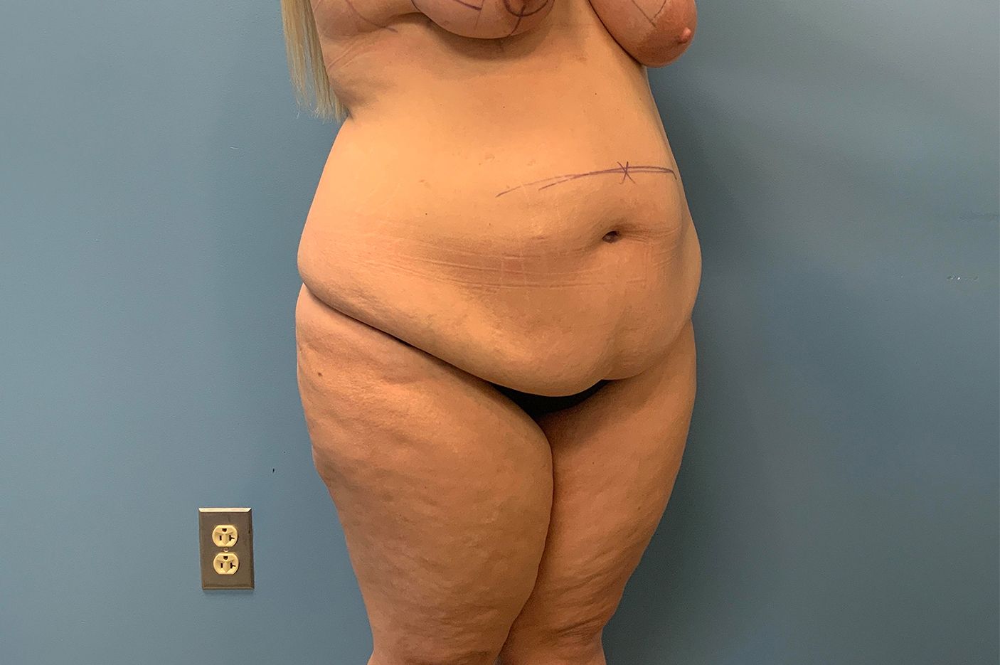 before surgery after weight loss right view female patient case 4493