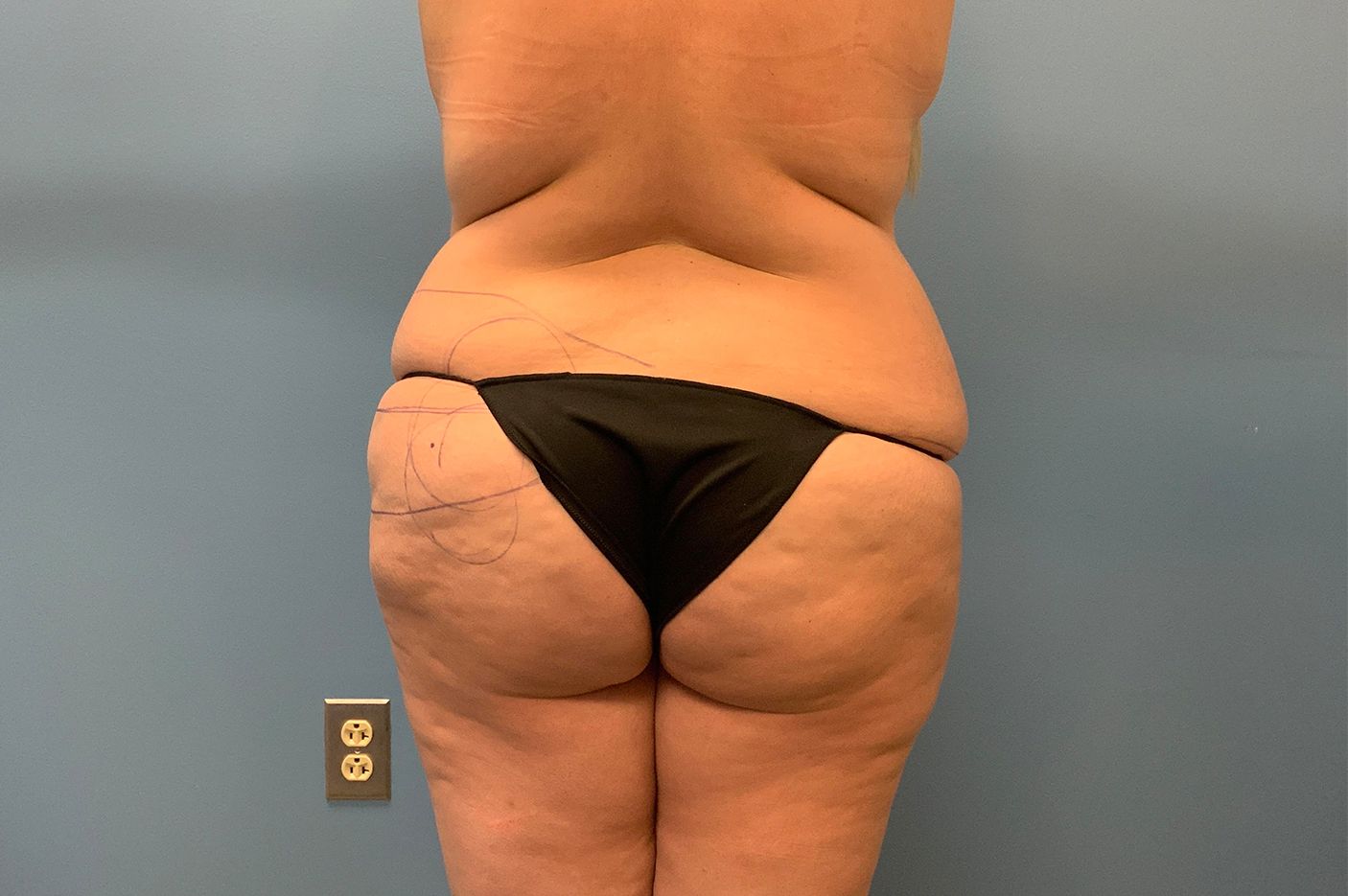 before surgery after weight loss back view female patient case 4493