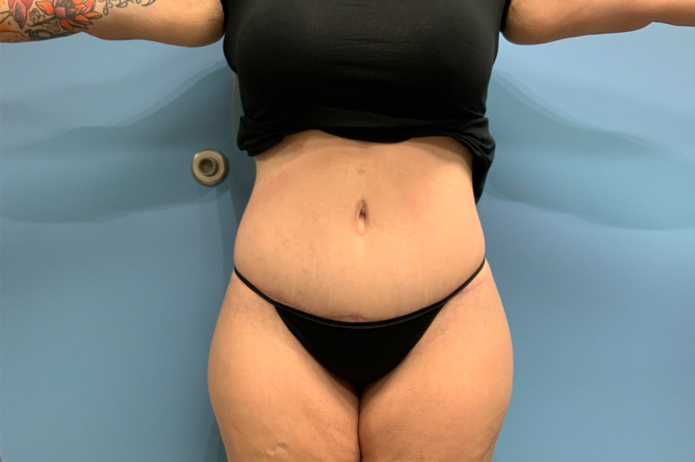 after surgery after weight loss front view female patient case 4493