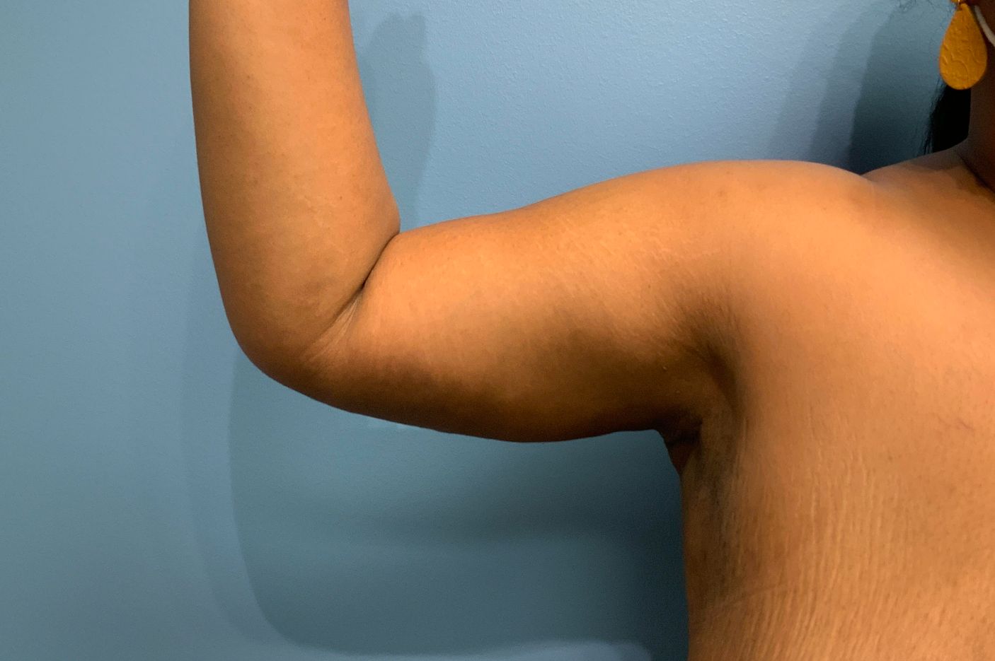 after surgery after weight loss front left arm view female patient case 4500
