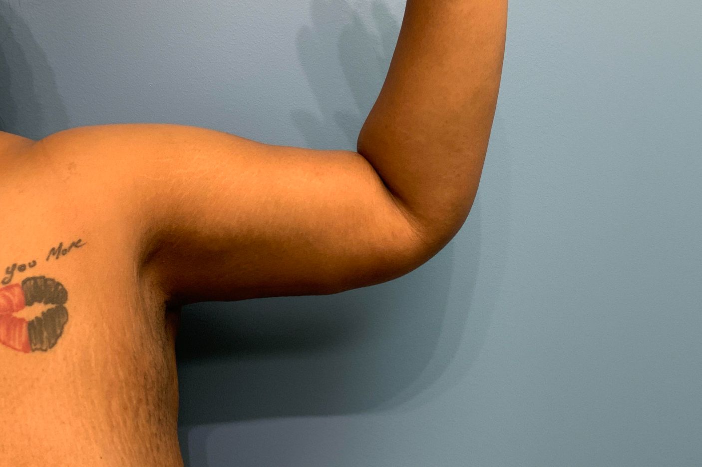 before surgery after weight loss front right arm view female patient case 4500