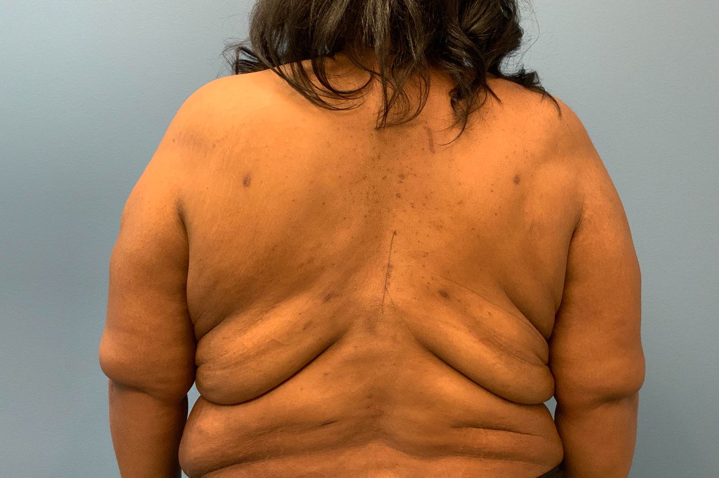 before surgery after weight loss back view female patient case 4500