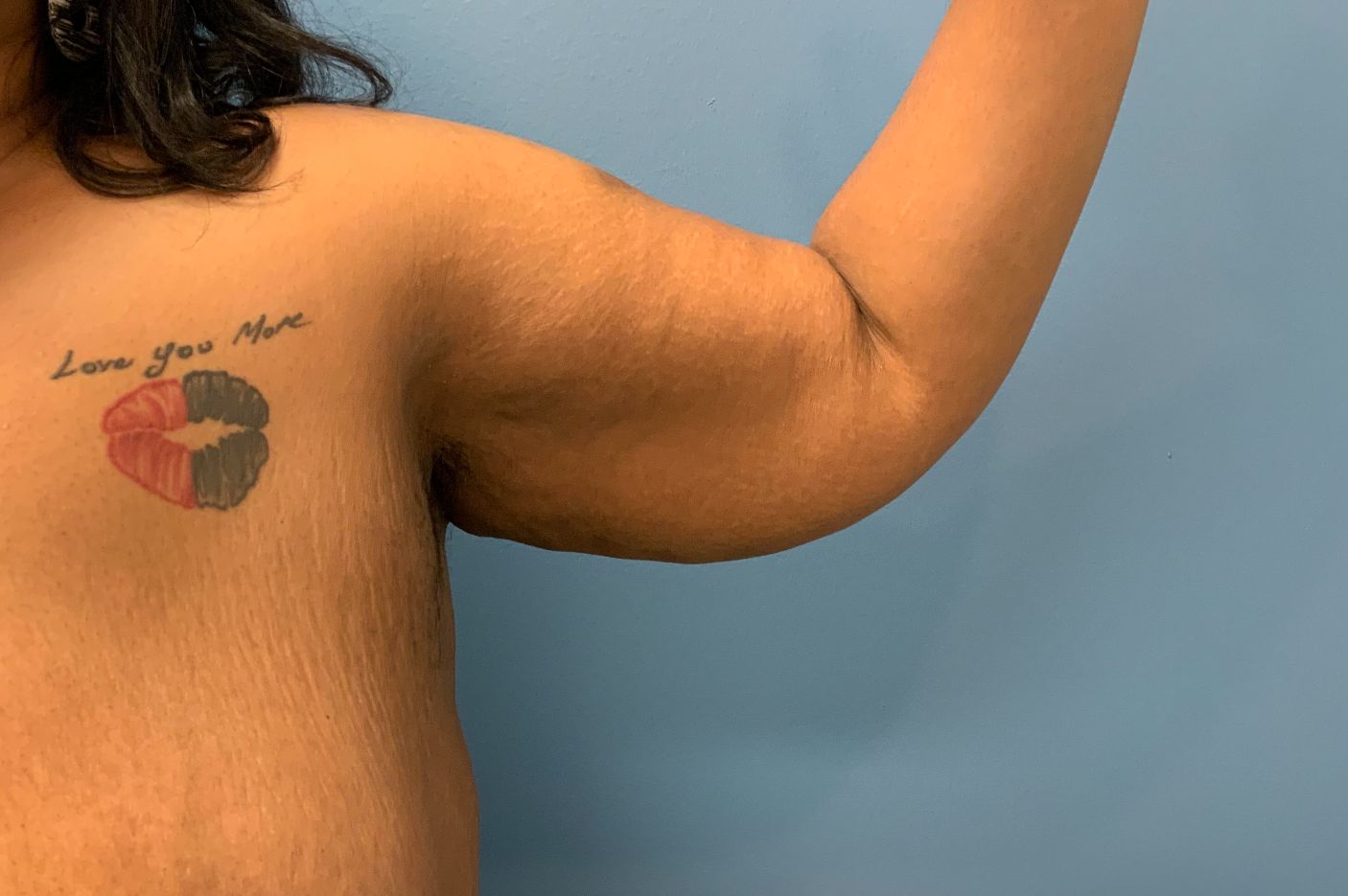 before surgery after weight loss front right arm view female patient case 4500