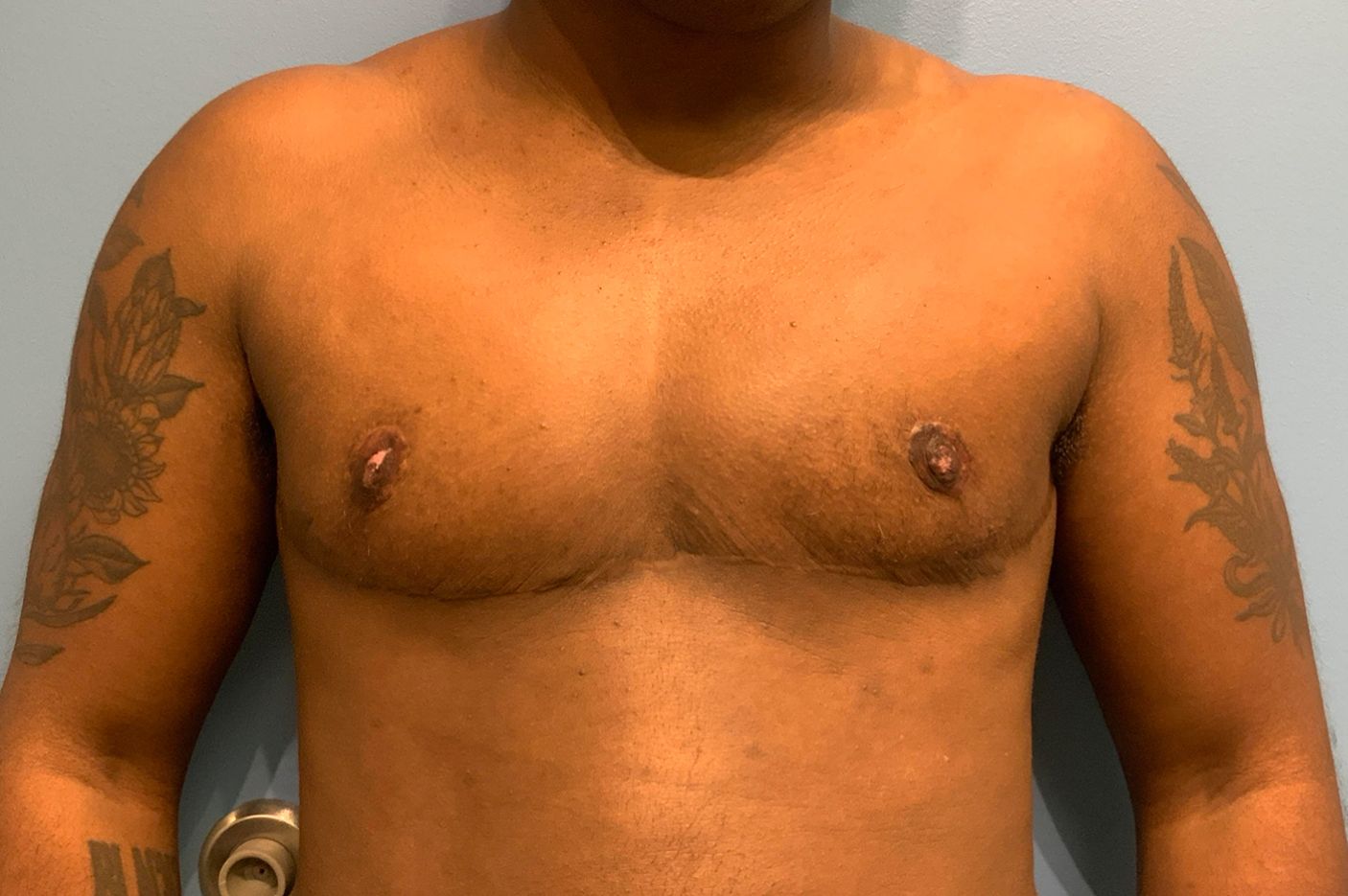 after transgender top surgery front view patient case 4528