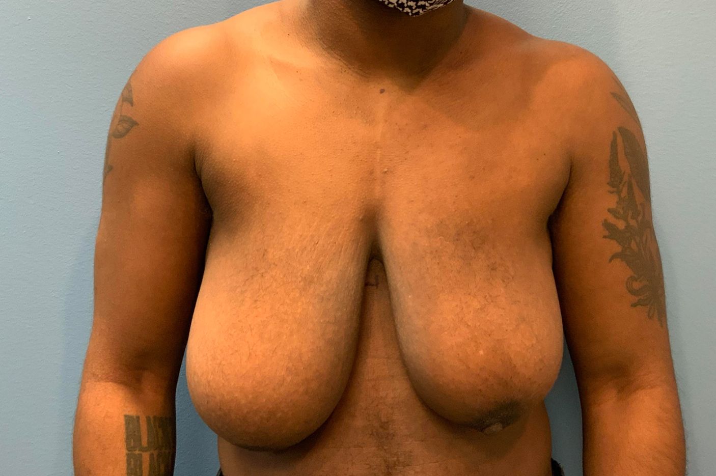 before transgender top surgery front view patient case 4528