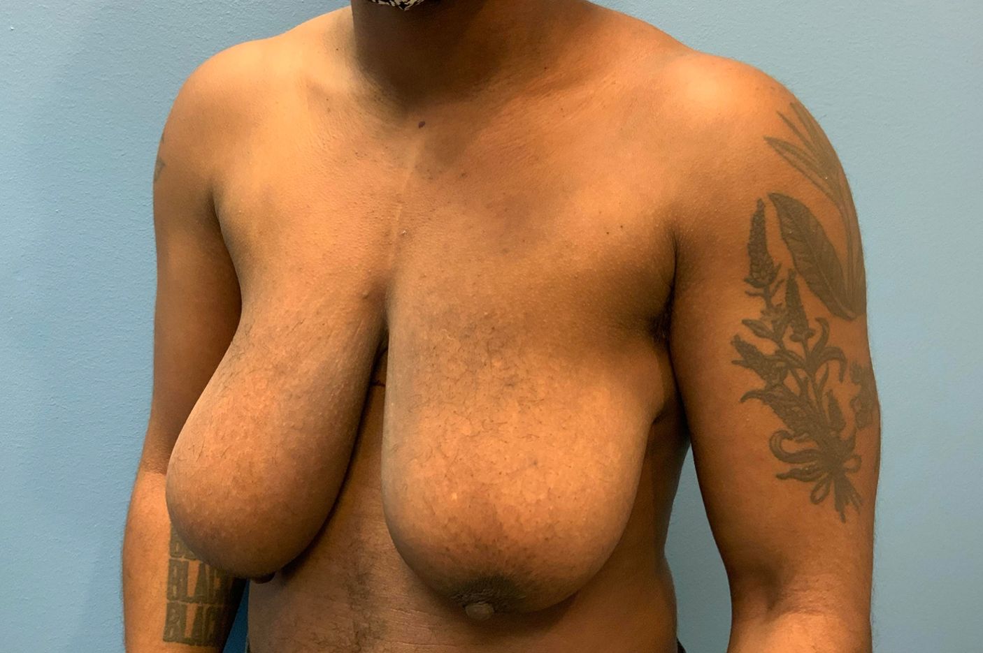 before transgender top surgery left view patient case 4528