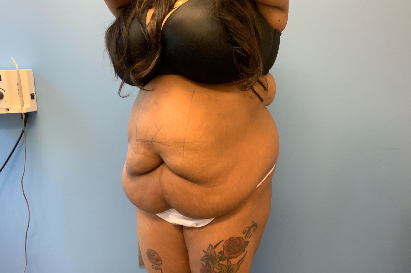 before tummy tuck left view patient case 4517