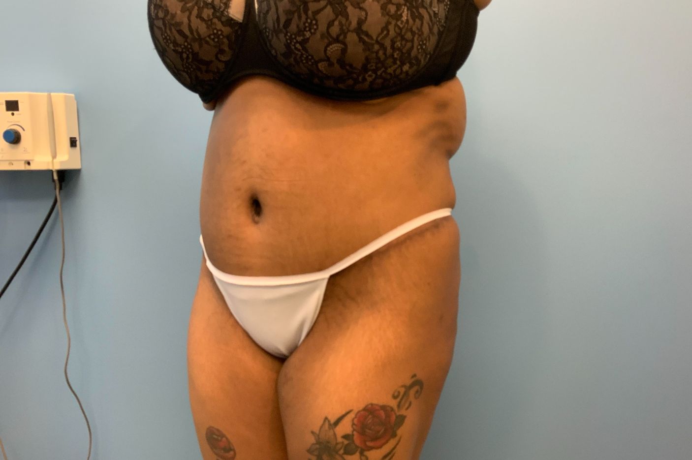 after tummy tuck left view patient case 4517