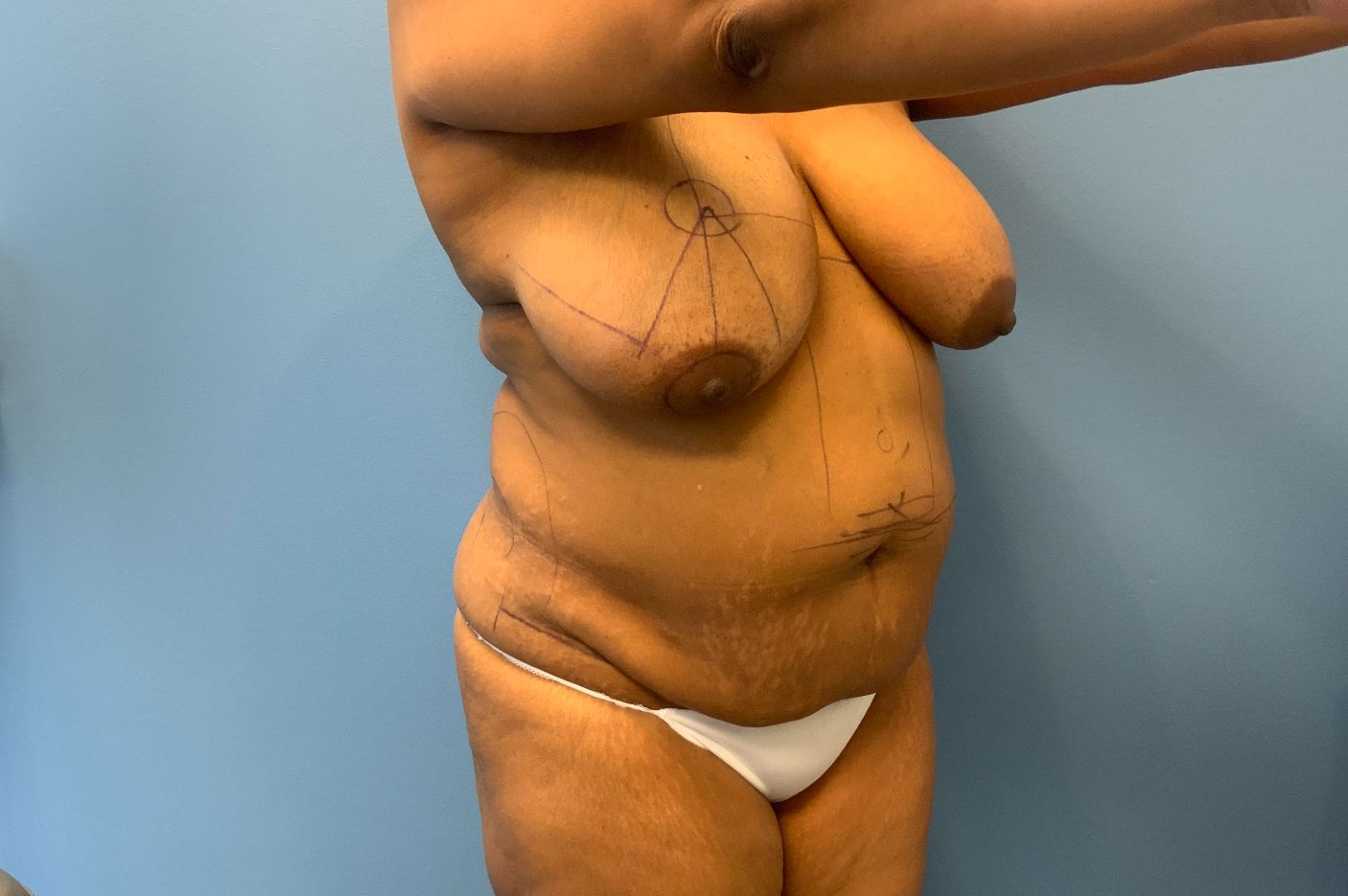 before tummy tuck right view patient case 4522