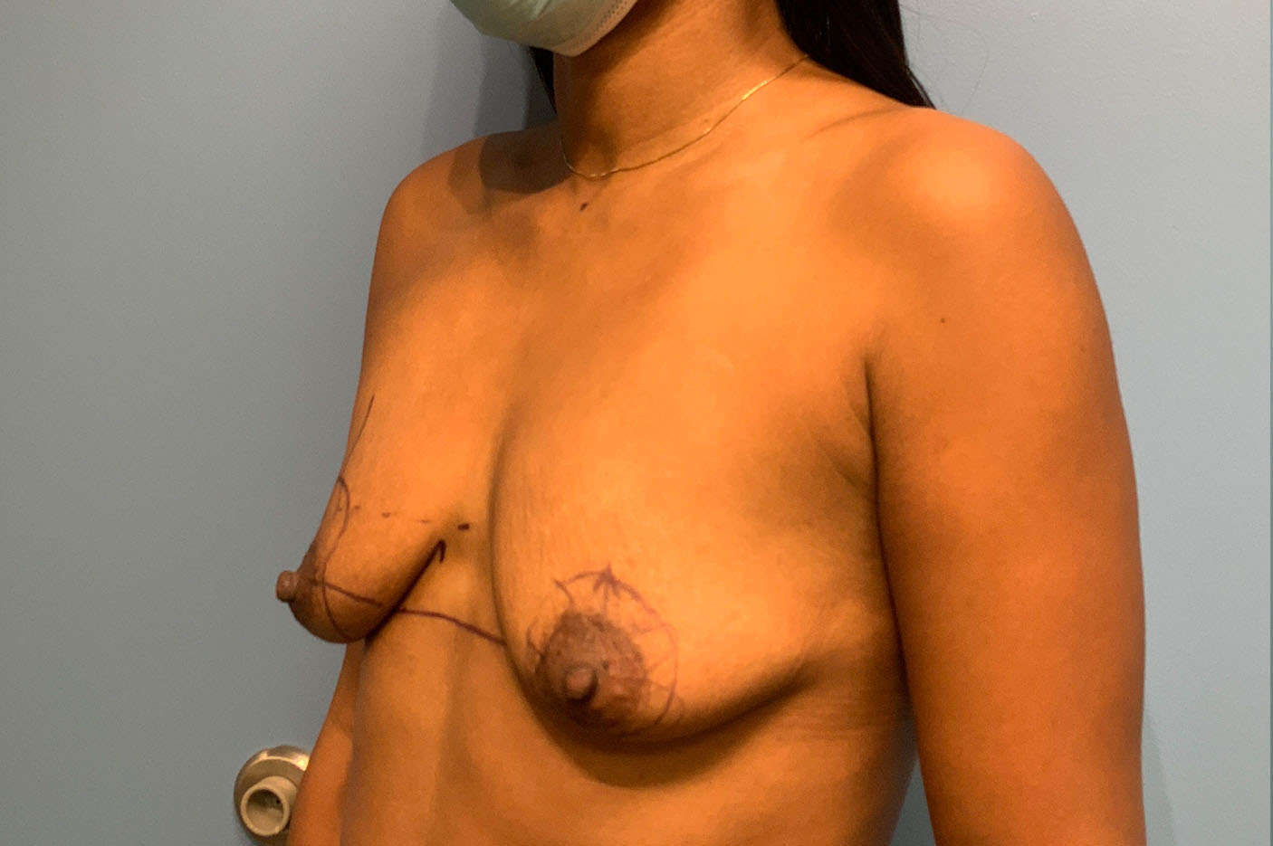 before breast lift left angle view of female patient case 4764