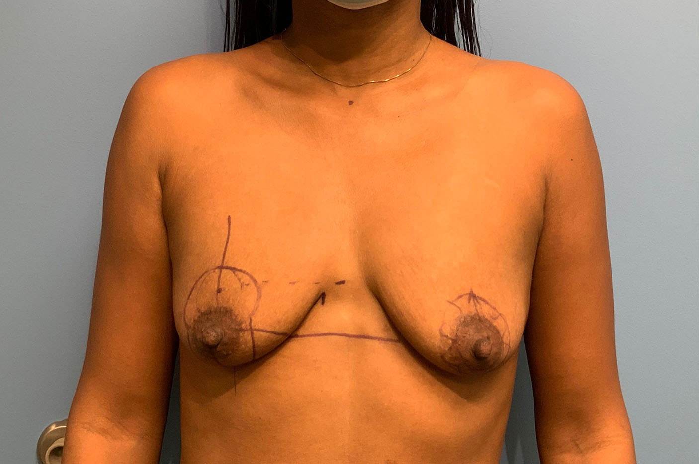 before breast lift front view of female patient case 4764