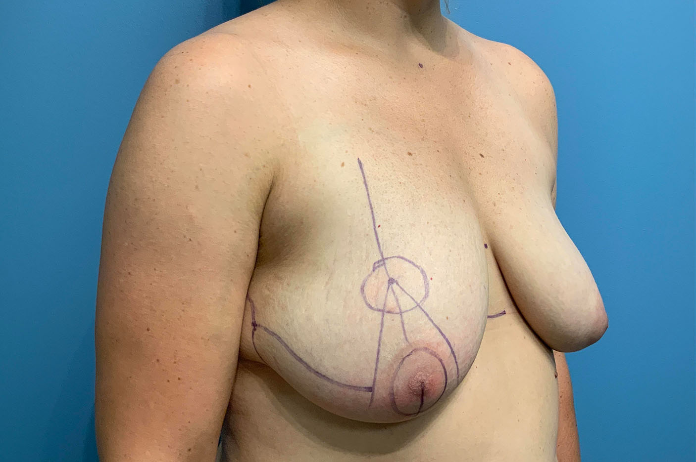 before breast lift right angle view of female patient case 4769