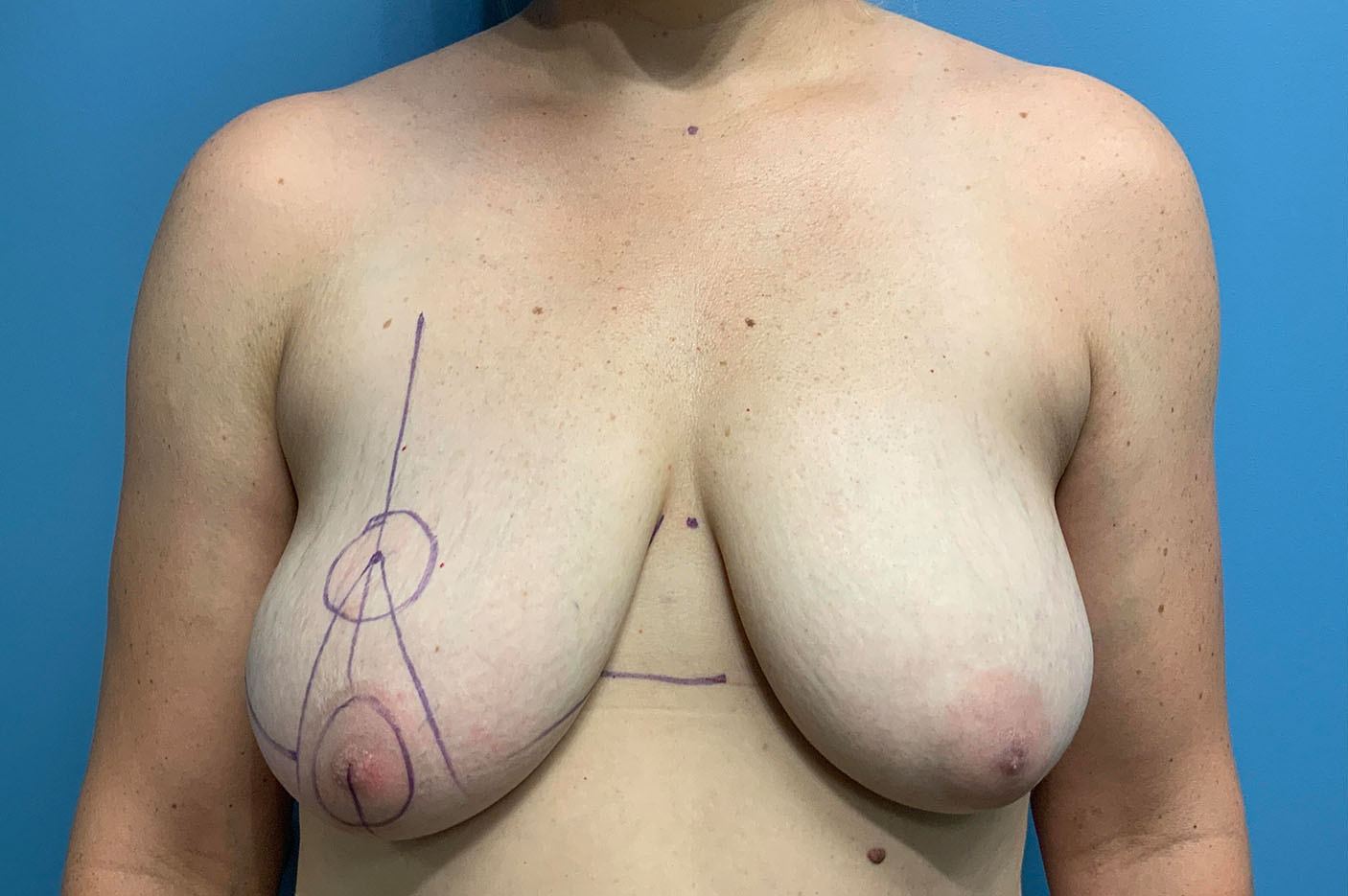 before breast lift front view of female patient case 4769