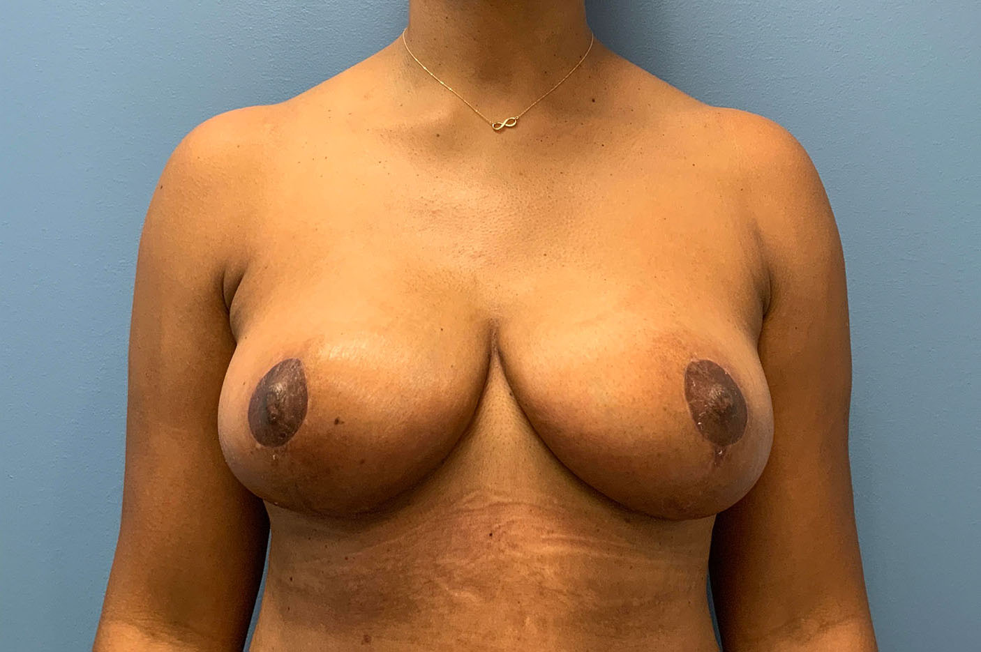 after breast lift front view of female patient case 4774