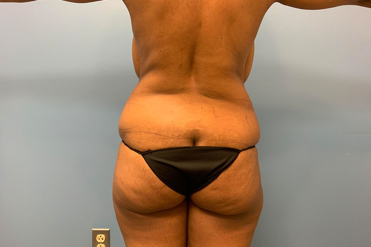 before liposuction front view of female patient case 4777