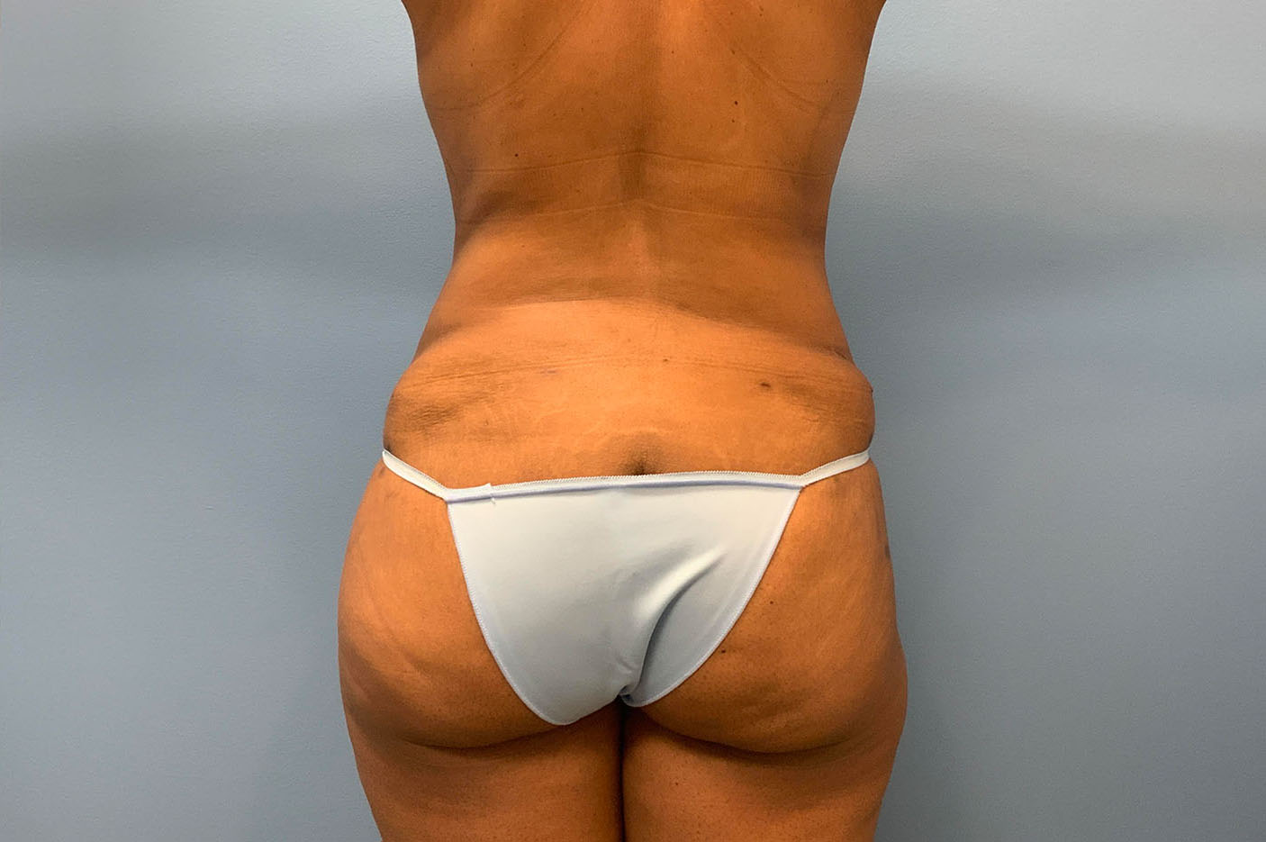 after liposuction front view of female patient case 4777
