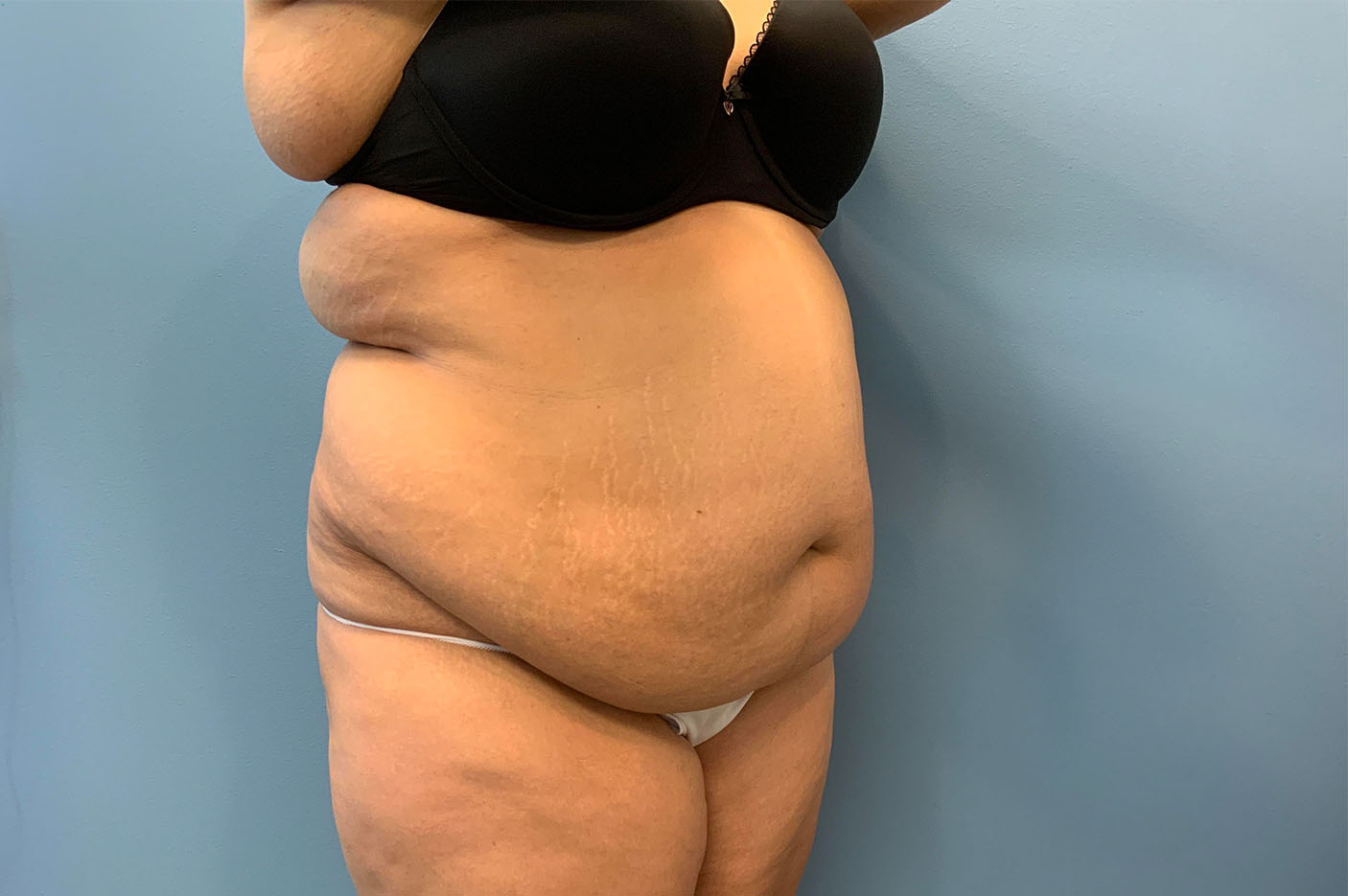 before tummy tuck right angle view of female patient case 4739