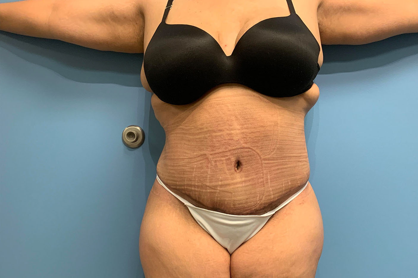 after tummy tuck front view of female patient case 4739