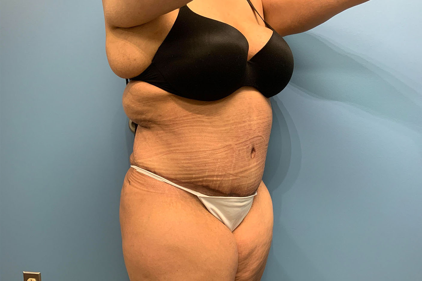 after tummy tuck right angle view of female patient case 4739